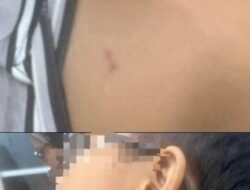 Penuh Memar dan Bekas Gigitan, Bocah Palembang Jadi Korban Kekerasan ART yang Dipercaya Keluarga